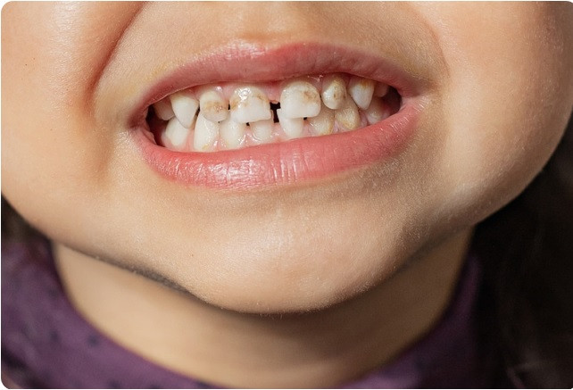 Lấy cao răng sữa cho trẻ có cần thiết?